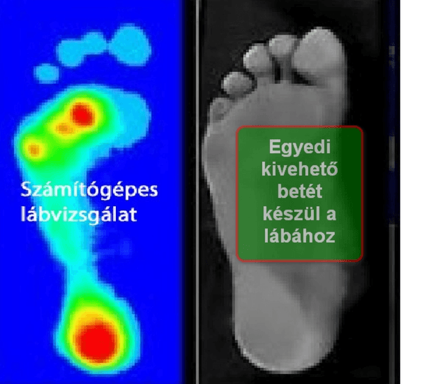 Lábtartás mérés monitoron