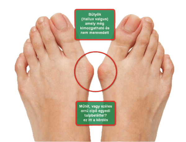 Hallux Valgus Láb